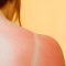 Natural Remedies to Reduce Summer Sun Skin Damage